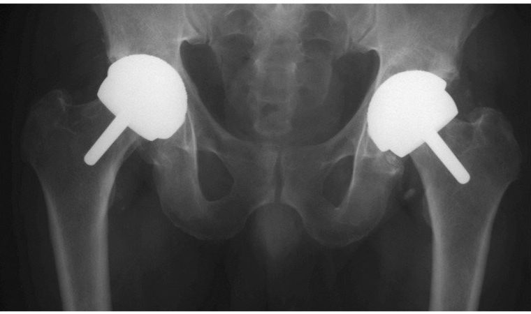 Smith & Nephew BHR Lawsuits Moving Forward in Hip Implant Litigation